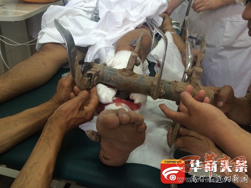 咸阳一周|咸阳男子小腿被刺穿 图片血腥 慎点!