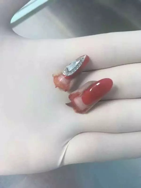 19岁幼师两节手指被瞬间拽断 罪魁祸首竟然是