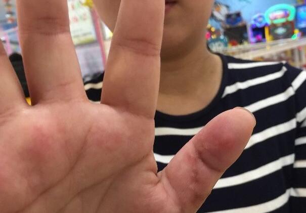 开水烫涮时玻璃奶瓶突爆炸 北郊女子拇指缝合19针