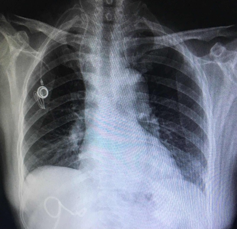安康市人民医院成功开展全市首例植入式静脉输液港