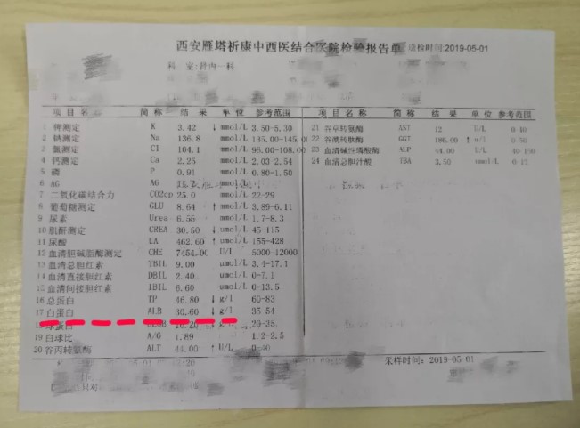 19岁少女双下肢肾病性水肿难消除 祈康肾内一科帮其排
