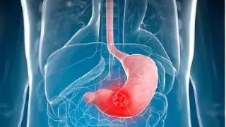 这4类人是胃癌的高发人群 一定要谨防！