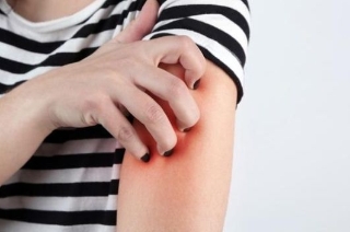 皮肤过敏不要不当一回事 小心诱发这5种并发症