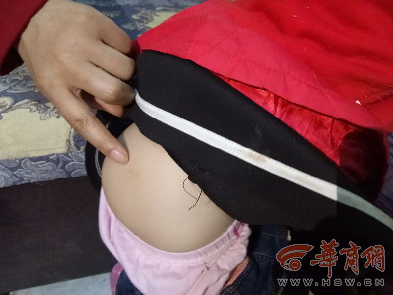 咸阳3岁女童屁股上咋有针眼?娃说幼儿园老师给她打针了