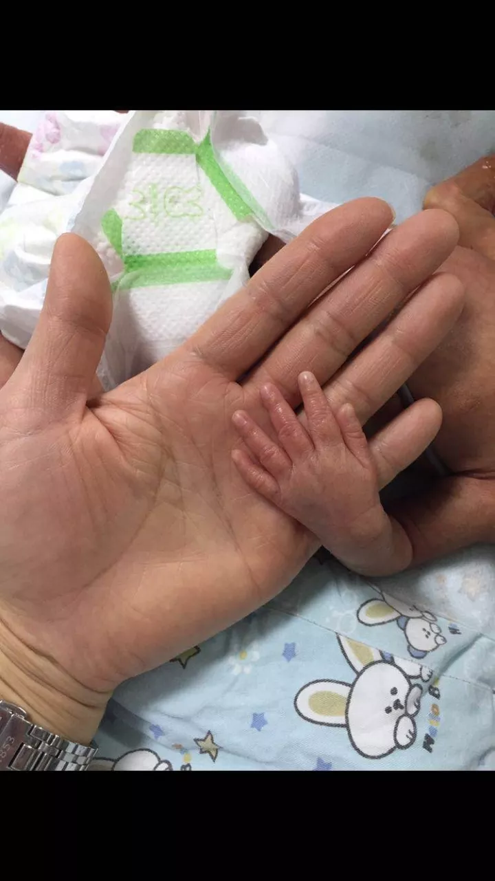 女子怀双胞胎7个月时早产 2斤哥哥坚强活下来