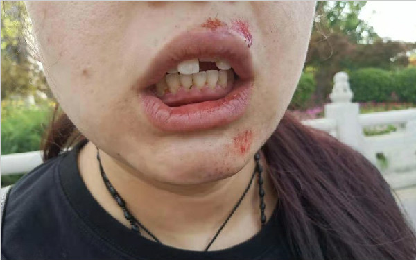 西安女子骑摩拜单车刹车时摔倒 两颗门牙受损全身多处擦伤